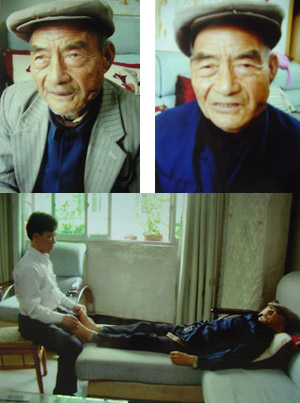 治神针法治疗高分化鳞癌医案/转 治神针法治疗高分化鳞癌医案/转